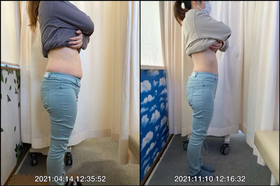 産後骨盤矯正(骨盤矯正)